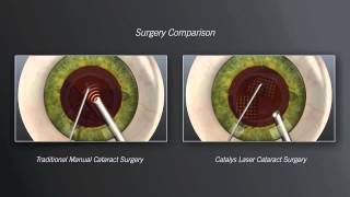 Catalys Laser Cataract Surgery vs Traditional Manual Cataract Surgery  Animation [upl. by Harret]