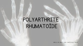 Polyarthrite Rhumatoïde PR [upl. by Lerud]