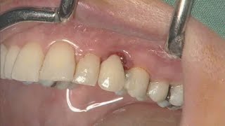 NobelActive clinical case immediate implant placement  Eric Rompen [upl. by Rame501]