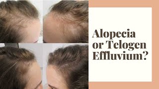 Alopecia or Telogen Effluvium [upl. by Siravat]