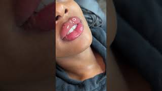 1ml needle less lip fillers touch up using the Hyaluron Pen [upl. by Ardnossac]