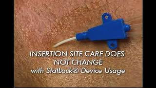 StatLock CV Plus Stabilization Device Application Procedure Video [upl. by Erodaeht365]