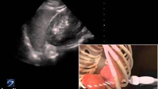 How To EFAST  LUQ Left Upper Quadrant 3D Video [upl. by Hayes]