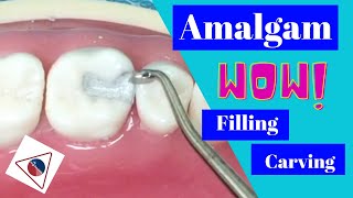 Amalgam Condensation and Carving Technique Tutorial  In Office to Hands On Dental Training [upl. by Nileuqcaj]