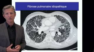 ECN PID cours 2 Fibrose pulmonaire idiopathique DFASM1 Pr V Cottin Lyon [upl. by Amaty791]