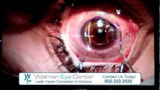 Lasik Vision Correction at Walman Eye Center  Phoenix Arizona [upl. by Hoffmann168]