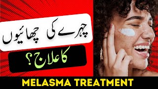 Melasma Treatment  Chaiyon Ka Ilaj  How to Fade Dark spots on skinamp face after pregnancy [upl. by Harutak357]