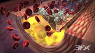 DiabetesRelated Atherosclerosis [upl. by Eniamrahs857]