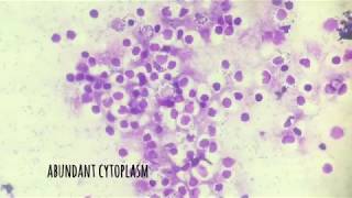 Transitional epithelial cells in urine [upl. by Perkins877]