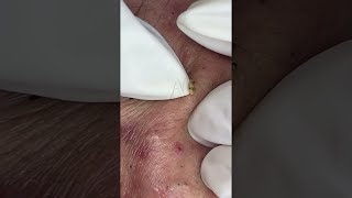 Big Cystic Acne Blackheads Extraction Blackheads amp Milia Whiteheads Removal Pimple Popping shorts [upl. by Nevi]