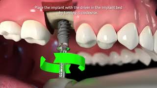 Straumann® TLX Implant System Step by Step [upl. by Chalmer]