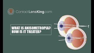 What is Anisometropia How is Anisometropia Treated [upl. by Yemac]