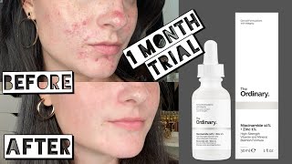 TESTING THE ORDINARY NIACINAMIDE AND ZINC FOR MY ACNE SCARRING FOR 1 MONTH [upl. by Yuh834]