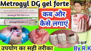 Metrogyl DG gel forte ke fayde  metrogyl DG gel forte uses in hindi  uses of metrogyl DG gel forte [upl. by Jollenta66]