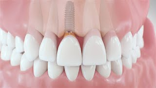 Dental Implant Procedure  Medical Animation [upl. by Wj908]