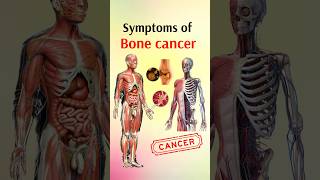 Symptoms of bone cancer shorts [upl. by Nabi]