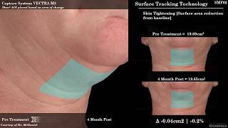 SculpSure for Submental Fat Reduction Under the Chin Fat [upl. by Madonia]