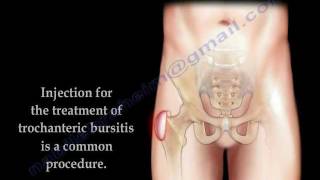 Trochanteric Bursitis Injection  Everything You Need To Know  Dr Nabil Ebraheim [upl. by Saffian]