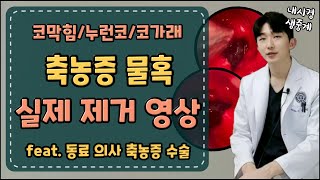 축농증 부비동염 실제 수술 내시경 영상Feat 동료의사 수술하기 [upl. by Adriene]