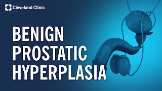 Prostate Biopsies Explained Transrectal vs PrecisionPoint® [upl. by Marylee]