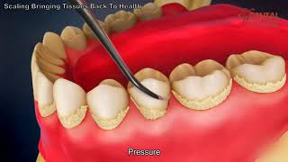 Teeth scaling to remove plaque  3d animated video  Dental Solutions Clinic Bangalore [upl. by Ytirev]