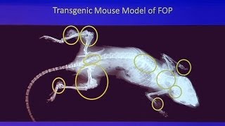 Genetic Mysteries FOP  When Bodies Turn to Bone [upl. by Martelli]