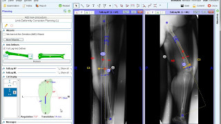 Orthodontic Treatment for Overjet Overbite  Forsus Appliance [upl. by Enitnelav]