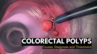 Colorectal Polyps Causes Signs and Symptoms Diagnosis and Treatment [upl. by Hutchings]