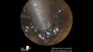 1381  Last Hope Ear Wax Removal for Patient in a lot of Discomfort [upl. by Kegan890]