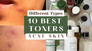 10 BEST ACNE Toners I have used  for different acne  oily skin dry sensitive combination [upl. by Enytsirhc696]