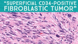 quotSuperficial CD34positive fibroblastic tumorquot  a mimic of sarcoma AIP France 2021  Case 15 [upl. by Yunick600]