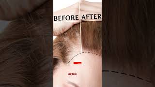 Minoxidil 1052 Mintop  Hair lossHair ReGrowBaldness Doctor Meds Uses In HindiampEngSub [upl. by Soelch]