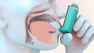 How to Use a MeteredDose Inhaler [upl. by Nilats]