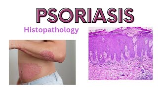 Psoriasis pathophysiology and histology  dermatology [upl. by Lamak894]