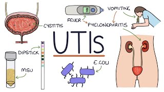 Understanding Urinary Tract Infections [upl. by Nies697]