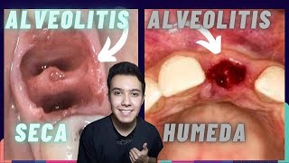 ALVEOLITIS HUMEDA Y SECA👅 CAUSAS TRATAMIENTO INFECCION DESPUES de una EXTRACCION DENTAL 🦷 [upl. by Anniken8]