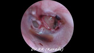 Double Traumatic Tympanic Membrane  Eardrum  Perforation [upl. by Esinal]