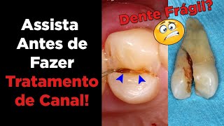 Tratamento de canal – Dentista Responde Dúvidas Sobre Canal no Dente  Preço e Como é Feito [upl. by Rtoip]