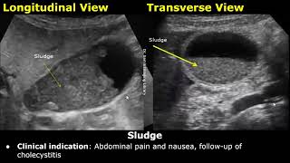 Gallbladder Ultrasound Reporting  GB Disease Scan Reports  How To Write USG Report  Abdominal USG [upl. by Otilrac]