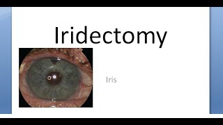 Ophthalmology Iridectomy Indications Procedure Surgical Iridotomy Difference [upl. by Atworth531]