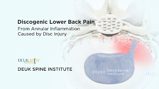 Discogenic Lower Back Pain  3D Animation [upl. by Hugo]