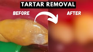 Huge TARTAR REMOVAL From Teeth  TEETH CLEANING [upl. by Aretina542]