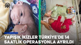 Pakistanlı yapışık ikizler Türkiyede 14 saatlik operasyonla ayrıldı [upl. by Haldane928]