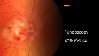 CMV Retinitis Fundoscopy [upl. by Hernardo]