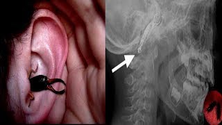 What Happens If An Earwig Gets Into Your Ear  Documentary EnglishHD [upl. by Clim30]