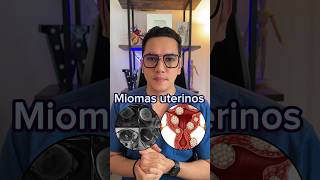 Miomas uterinos todo lo que debes saber parte 1  Dr William Guerrero medicina shorts [upl. by Gauthier461]