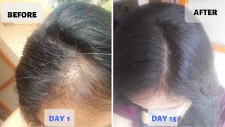 OMG  15 Days Hair Growth Miracle Treatment  Grow Long Thicken Hair  100 works [upl. by Kari843]