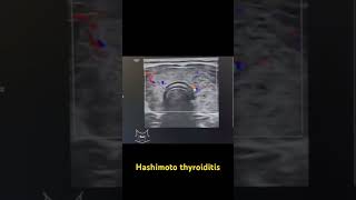 Hashimoto’s thyroiditisultrasound imaging viral medicalimaging learning medicine doctor [upl. by Anaerol]