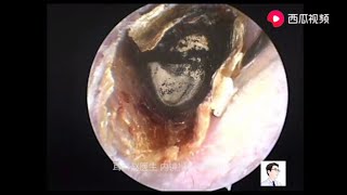 Fungal examination of the external auditory canal dry cerumen and cholesteatoma 10 minutes [upl. by Dixon]