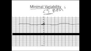 NonStress Test Made Simple [upl. by Tower665]